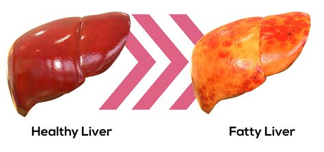 Unraveling Non Alcoholic Fatty Liver Disease Faculty Of Medicine