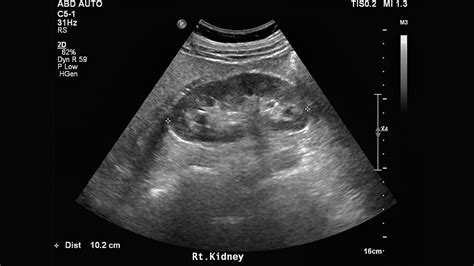 kidney renal ultrasound procedure preparing