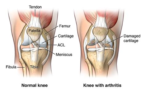 Knee Replacement Surgery Health Encyclopedia University Of