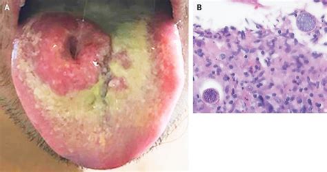 Fungal Infection In An Hiv Positive Patient Medizzy Journal
