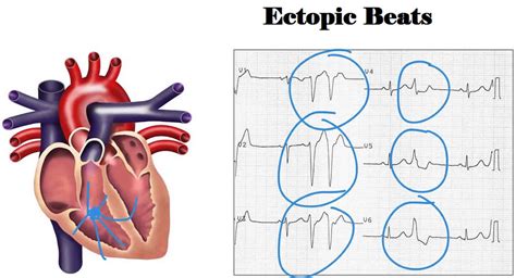 ectopic beats  symptoms diagnosis treatment prognosis