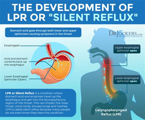 silent reflux symptoms   support strategies silent reflux