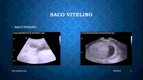 Ultrasonido Temprano Con Saco Gestacional Saco Vitelino Y Embrion 36660