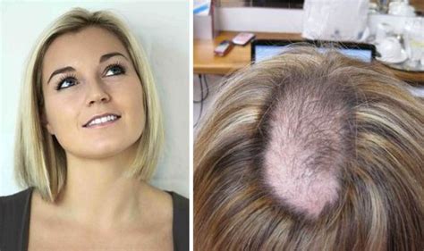 Trichotillomania Sufferer Katie Neiman On Her Hair Pulling Condition
