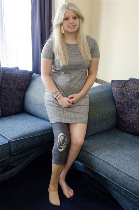 Teenage Hairdresser Lost Her Leg After Doctors Dismissed Her Melon Like
