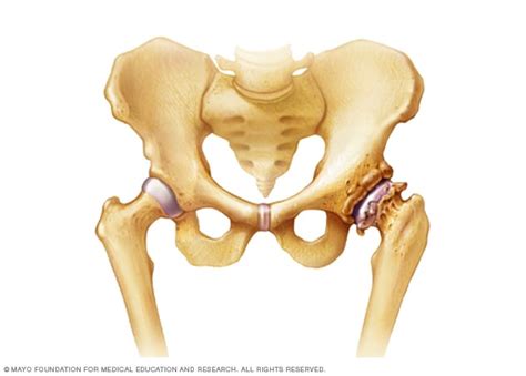 osteoarthritis symptoms   mayo clinic