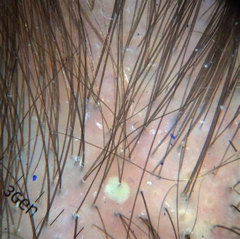 scalp folliculitis   single entity donovan hair clinic