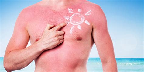 zonneallergie tips om het te voorkomen sunweb