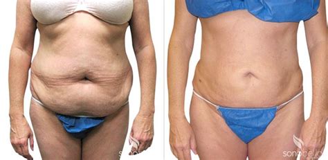 Before And After Gallery Sono Bello Total Body