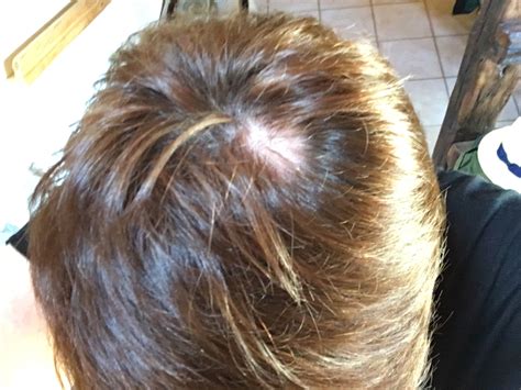 bald patch   head menopause forums patient