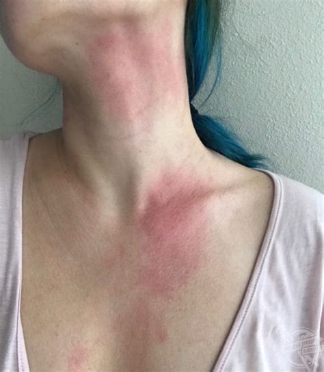 photographers skin breaks   agonising red raw rashes     contact