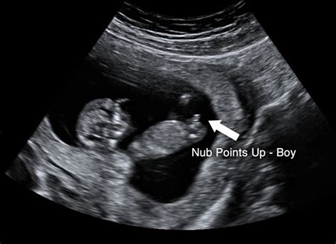14 weeks pregnant ultrasound gender