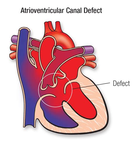 defecto del canal auriculoventricular completo cavc  red  women