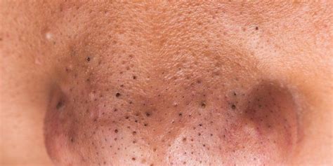 how to get rid of blackheads on your nose men s health