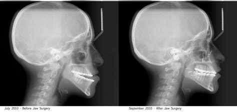 Surviving Jaw Surgery Beforeandafter
