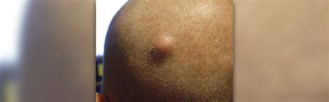 natural cure sebaceous cyst general center