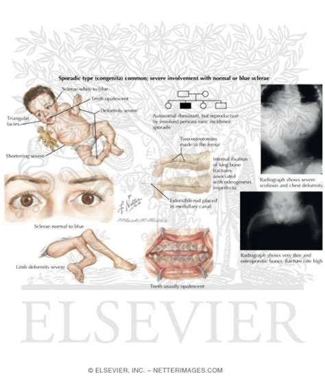 Characteristics Of Osteogenesis Imperfecta