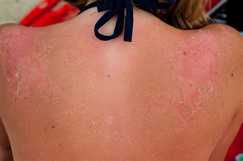 wat te doen bij zonnebrand   tips bij zonnesteek  verbrande huid
