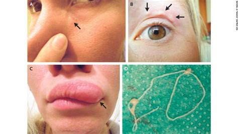 lump on woman s face turns out to be parasitic worm cnn