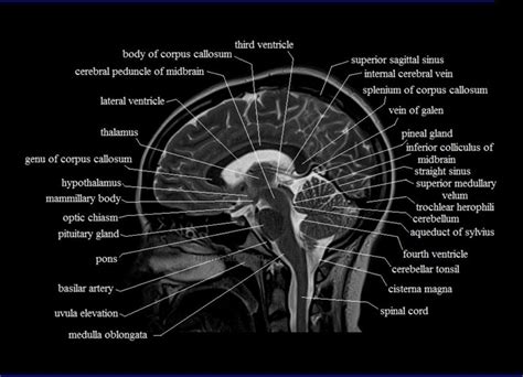 anatomy brainstem mri mri scan images