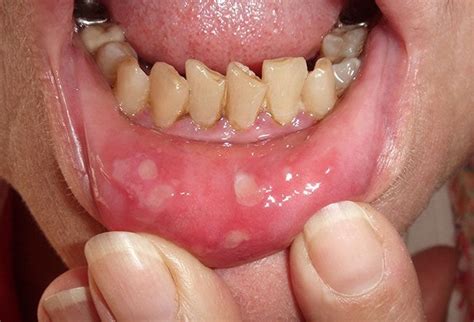 hand foot and mouth disease in mouth 2 picture image on