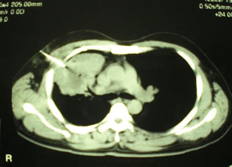 A Mass Shadow On Chest X Ray In A 40 Year Old Man Whats Your Diagnosis