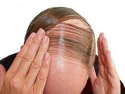 mengatasi rambut rontok parah  cepat duajarico rambut