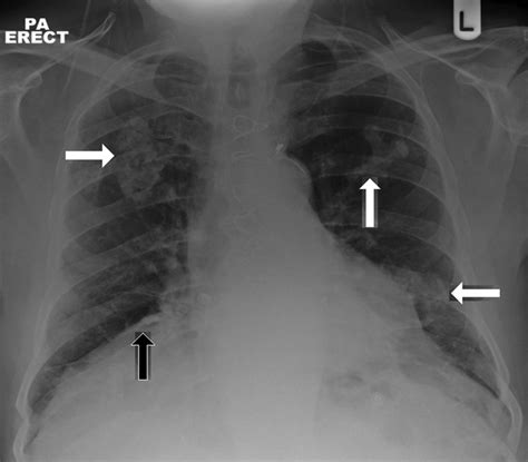 Asbestos Related Pleural Plaques Significance And Associations