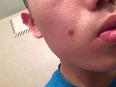 infected pimple   general acne discussion acneorg forum