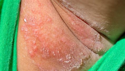 rash under armpit std