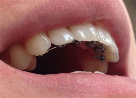 de moderne beugel  compleet onzichtbaar en zit vast achter je tanden orthodontie beugel