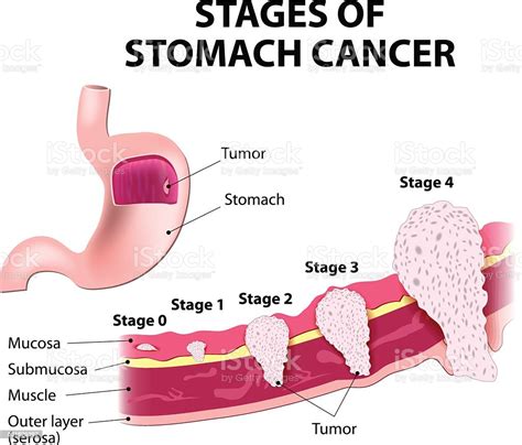 Staging Of Stomach Cancer Stock Illustration Download Image Now Istock