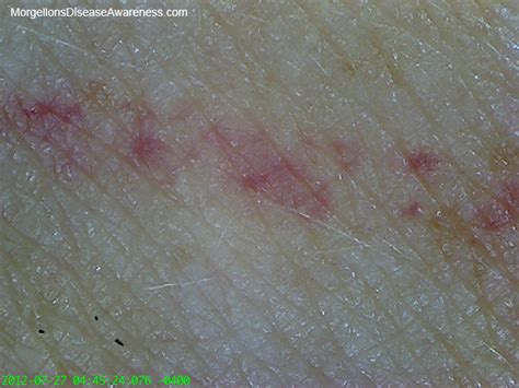 morgellons disease awareness artist and morgellons sufferer ayla journals her experience