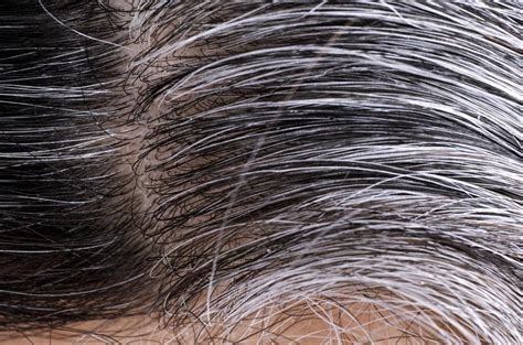 white hair causes and ways to prevent it