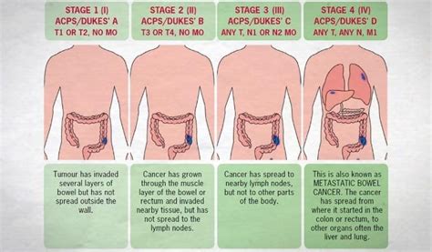 Top 13 Early Warning Signs Of Colon Cancer To Beware