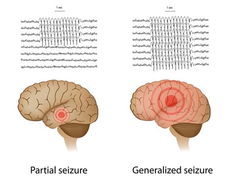 Epilepsy Special Needs