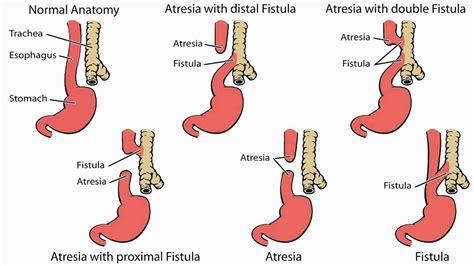 Esophageal Atresia And Tracheoesophageal Fistula Causes Symptoms And Treatment