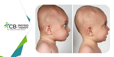infant head shape  physiotherapy   attain   head