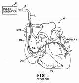 Sinus Coronary Catheter Patents Patent sketch template