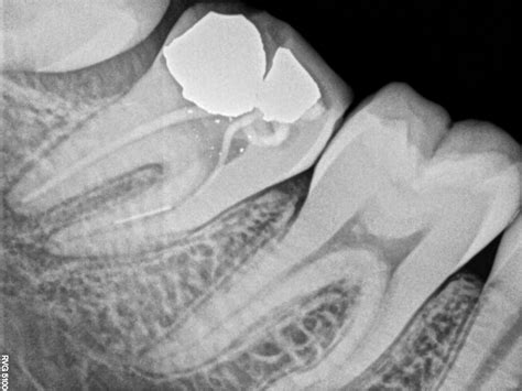 sevadharma dental clinic  treatment     molar