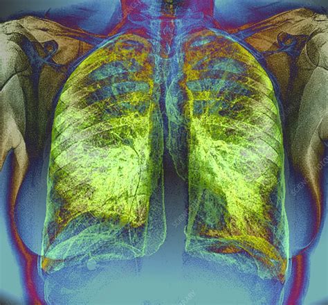 Healthy Lungs Ct Scan Stock Image C048 8760 Science Photo Library