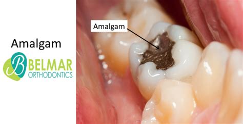 amalgam belmar orthodontics