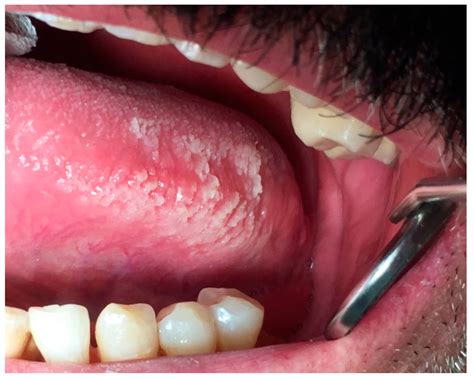 raspaw red  white lesions  oral cavity
