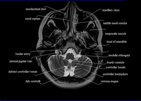 mri anatomy  mri axial brain anatomy brain anatomy mri anatomy
