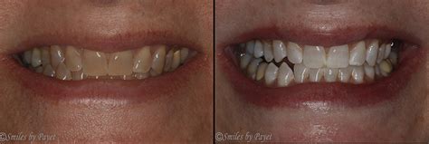cosmetic dentistry smiles by payet dentistry cosmetic