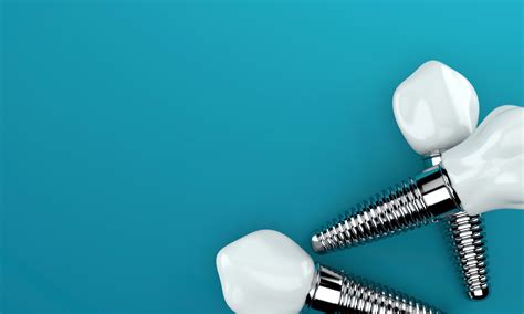history  dental implants birmingham al