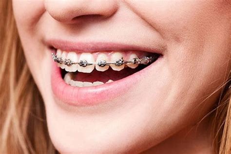 fixed metal braces southsid  orthodontic clinic