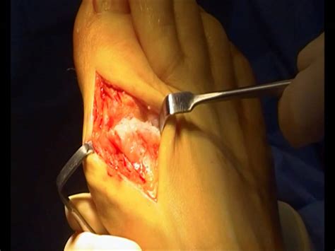video big toe joint arthritis