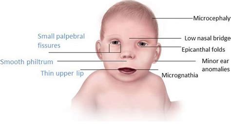 fetal alcohol syndrome facial features picture naked photo