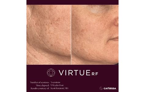 virtue rf microneedling specialist chelmsford ma   skin